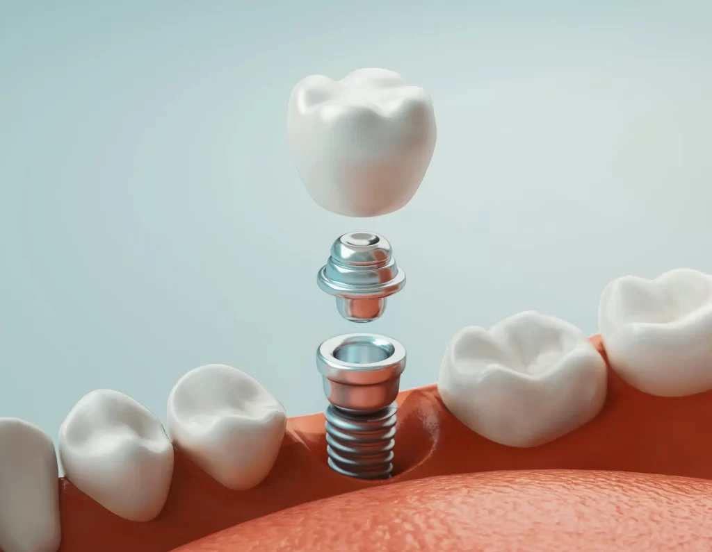 Dental Implants Brisbane