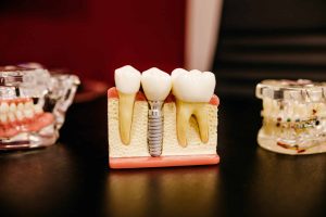 affordable Dental Implants Brisbane