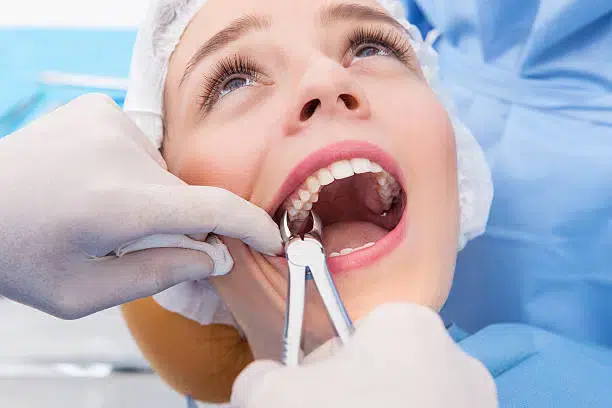 Tooth Extraction Brisbane
