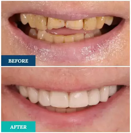 dental implants before after brisbane