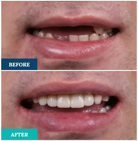 tooth implants before after brisbane
