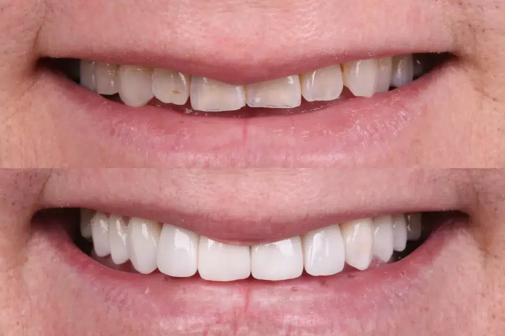 dental veneers before after brisbane