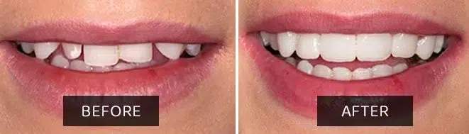Composite Veneers Before and After