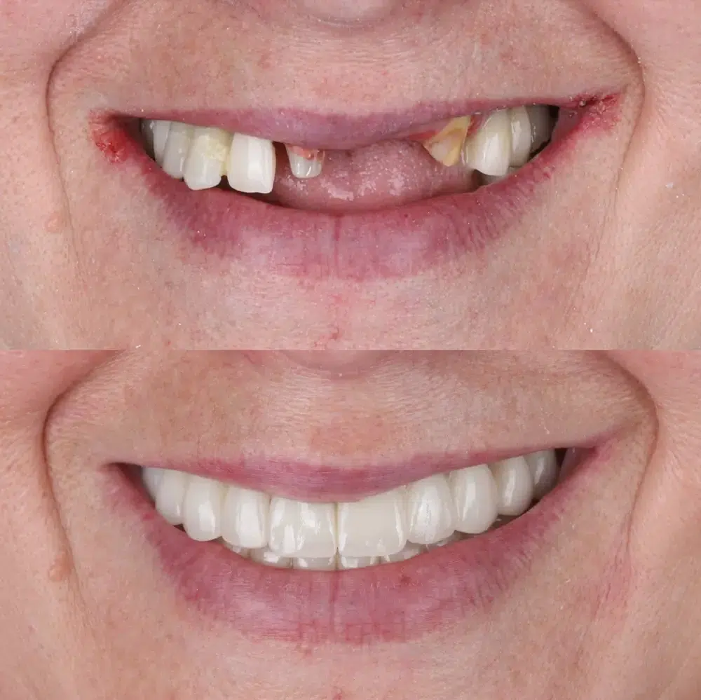 Affordable Dental Implants in Brisbane